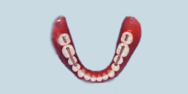 Synthetic Polymer Teeth – Seniors
